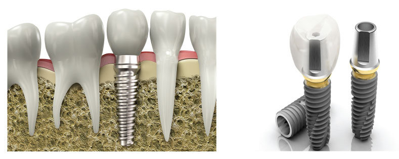 Dental Implants Tilbury